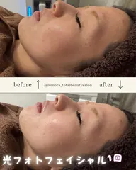 シミ・ソバカスケア💎✨光フェイシャルエステ🧖‍♀️