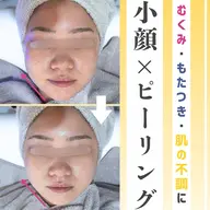 〈NEW🐰〉お好きなピーリング➕小顔施術➕ドライヘッドスパ🫧