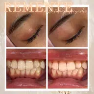 【眉毛ワックス+ホワイトニング】今月3名様限定🌹2点同時施術でコスパよく垢抜け✨低刺激ワックスと歯科医師監修液剤🦷