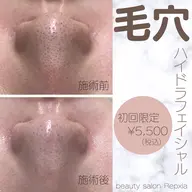 【ハイドラフェイシャル♪】新鮮な水素を発生させ洗浄と吸引で頑固な皮脂や角栓を一掃!ニキビのお悩みにも最適♪