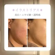 美白を手にれたい方🙋♀️💕シミ・ニキビ跡・色素沈着・くすみ改善💕クリスティーナ【イラストリアス】✨