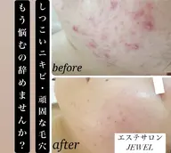 【モニター募集!】ハーブピーリング&毛穴洗浄(鼻のみ)70分