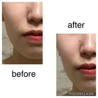 【超音波3D小顔リフトアップ/フェイスライン・頬】輪郭スッキリ！その場で実感✨