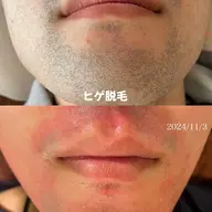 ヒゲ脱毛