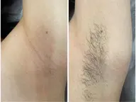 【全員/男女/自己処理によるくすみ・ポツポツに】両脇ワックス＋光脱毛¥2980