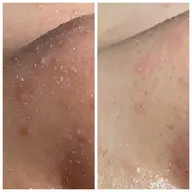 《初回限定》毛穴洗浄