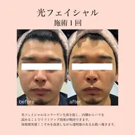 光フェイシャル