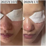 【人気No.1毛穴黒ずみ集中ケア】デコルテ＋ヘッドスパ付 90分 通常料金13,000円