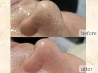 メンズOK◎【黒ずみ/毛穴/角質】お悩みに合わせてオーダーメイドスッキリ毛穴洗浄♪