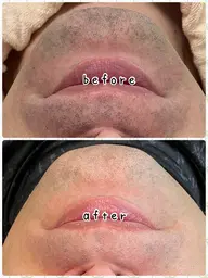 【メンズ】ヒゲ脱毛