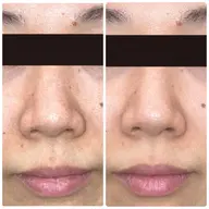 【毛穴開き・黒ずみ集中ケア】毛穴洗浄/選べるパックでつるん肌実感 30分 ¥7700→¥5500