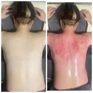 カッピング痩身 上半身25分