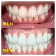 【大人気】ホワイトニング90分コース☆本気で歯を白くしたい方へ✨1日2名限定特別コース✨日本初‼️