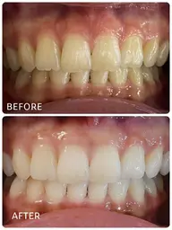 ホワイトニング🦷期間限定‼️お試し3回コース🦷✨(現金払い)