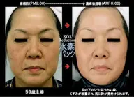 水素ガス🔵フェイシャルエステ　地球🌏で一番小さな元素の力✊