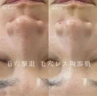 《毛穴が気になる方!キュッと引き締まる美肌へ!》REVI陶肌トリートメント◎¥18,150→¥13,750