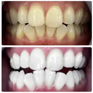 💁🏻♀️会員様メニュー💎✨2回照射🦷