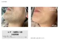 全顔脱毛パック