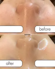 韓国NO1人気🇰🇷乳酸菌セラピール＋イオン導入＋パック【渡韓なしで韓国で流行りの肌管理✨毛穴・くすみ・ニキビ】