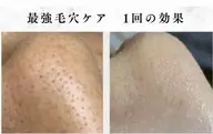 【本気の毛穴対策】歴26年のプロによる毛穴洗浄/通常￥26000→￥8800