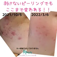 1番人気！碧ハーブピーリング80分初回カウンセリング60分お土産付♪