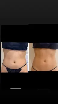 【男女】脂肪除去 身体1部位 (10ml)