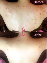 背中ニキビ撃退コース
