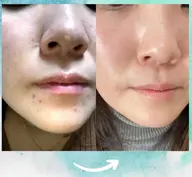 【韓国女優のような陶器肌】🧡つるりん毛穴レス体験🧡[兵庫県尼崎市/痩身エステ]