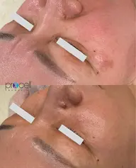 プロセルセラピーズ×肌再生エステ