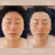 【メンズ☆ミニモ限定🌟】小顔矯正＋上半身ほぐし付🉐本場韓国直伝🇰🇷小顔コルギ🔥オイルマッサージ付き🌙