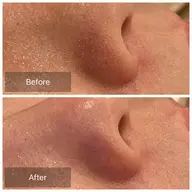 美脳小顔矯正&ハイドラフェイシャル毛穴ケア