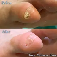 【副爪】痛みがある方❗️引っかかって困ってる方⚠️専用の器具で優しく、効果的に施術します！