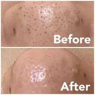 《小鼻》ハイドラ🩵いちご鼻／鼻の黒ずみ角質撃退👋【メンズもok】