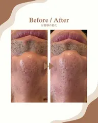 メンズ肌管理👨🏽✨毛穴ケア付き!