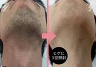 美肌✨メンズヒゲ脱毛➕保湿パック付き💎鼻下~首