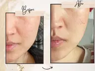 【たるみケア】動画撮影モデル(目隠し)!【現在受付停止 4月から再開】