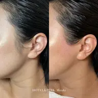 【もみあげワックス脱毛】コンプレックス一瞬で解消!