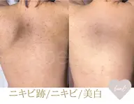 残り2名背中ニキビケア/跡】上半分/最高級★剥離有ハーブピーリング¥60000→