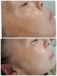 CSP クリアスキンプログラム　フェイシャルワックスフラッシュマジック