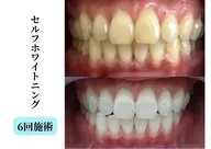 【プラチナホワイトニング】Newプラン★15分×15分照射で素早く汚れを分解し落とす♪《初回限定💫特別価格》