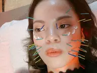 小顔効果抜群!美容鍼+小顔整体コース