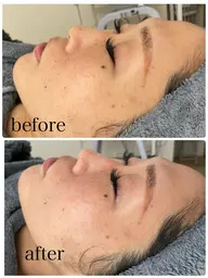 【水光美肌を育てる】ララピール＋専用ゲルマスク（全顔＋首）