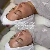 【 🎀 オープン限定特別価格 🎀 】ラレステン艶肌ピーリング+小顔・デコルテリンパ付 150分 ¥7,500