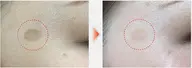 シミ改善トリートメントss(1〜2mm)シミ1ヶ所 ¥880
