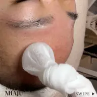 ニキビケアフェイシャル