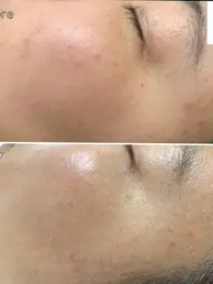 イオン導入の約120倍浸透力プラズマ+ララピール　ファンデーションなしでも内側から輝くお肌へ。￥12600→￥8800