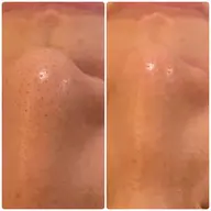 ★ハイドロスプラッシュ毛穴洗浄コース★