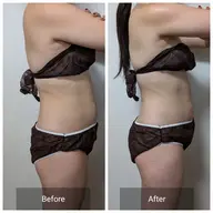 上半身すっきりセルライトケアコース40分エステ