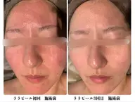 ララピール×アクアグロウリフト/毛穴・たるみ改善◎透明感UP💎✨