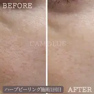 ハーブピーリング(剥離なし)